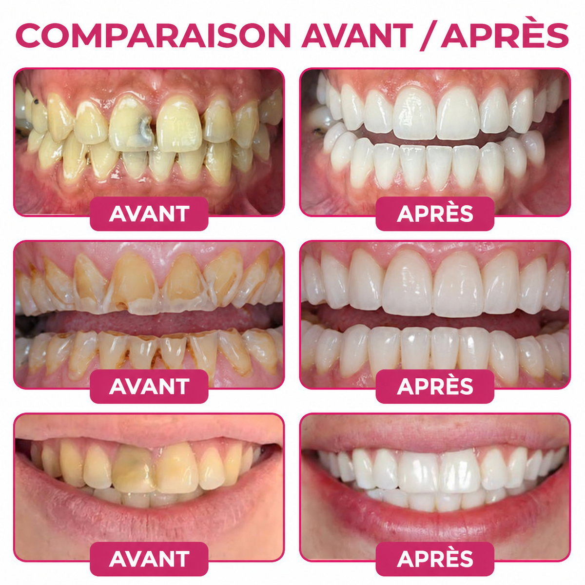 Rolimey® DenPerm | Gel naturel de réparation des caries et de l’émail dentaire