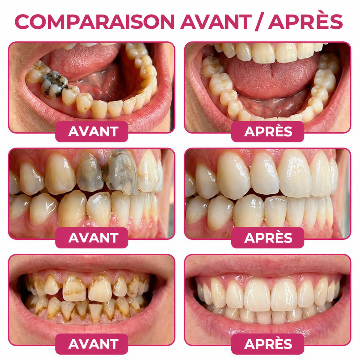 Rolimey® DenPerm | Gel naturel de réparation des caries et de l’émail dentaire
