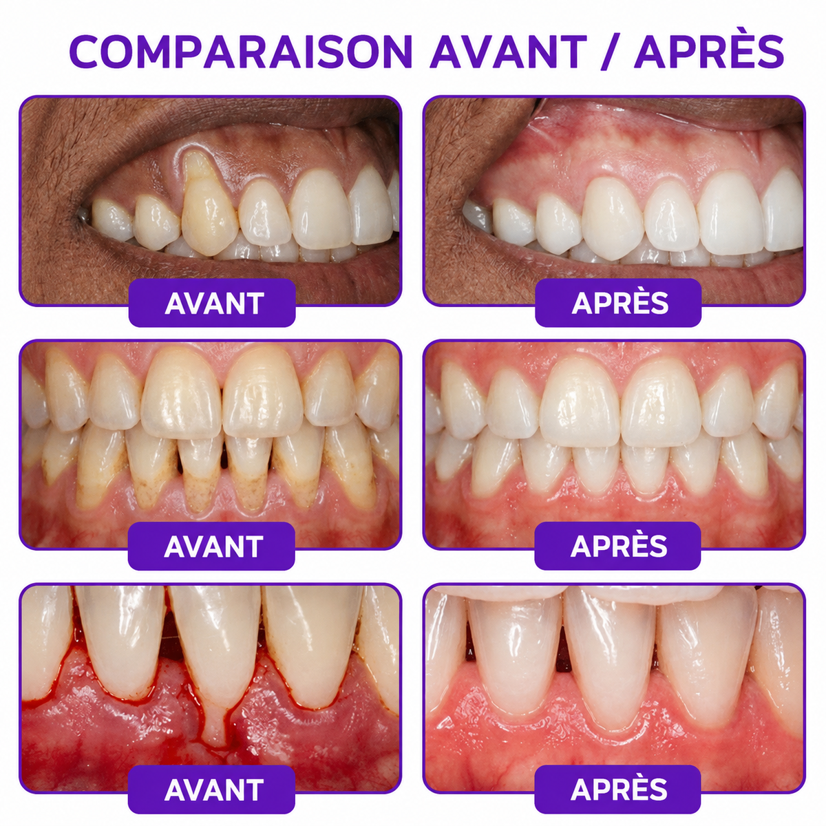 Rolimey® VioCore : Dentifrice au venin d’abeille pour la gingivite et la parodontite