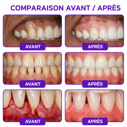 Rolimey® VioCore : Dentifrice au venin d’abeille pour la gingivite et la parodontite