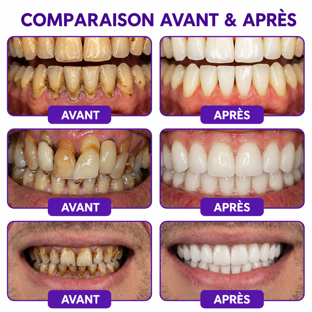 Rolimey® VioCore : Dentifrice au venin d’abeille pour la gingivite et la parodontite