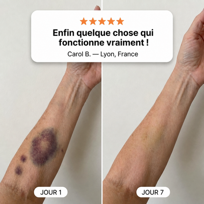 🔥 Celsiora® Crème anti-hématomes – Soin intensif pour les peaux sensibles sujettes aux bleus
